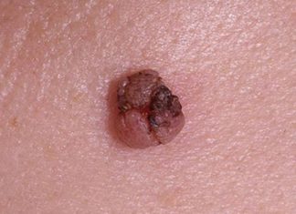 Прижигание папиллом нашатырным спиртом