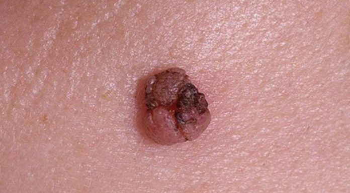 Прижигание папиллом нашатырным спиртом