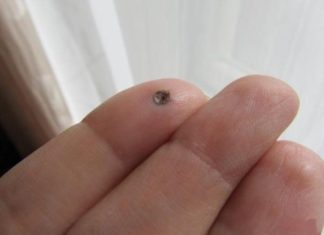 Уход за ранкой после удаления бородавки