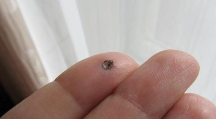 Уход за ранкой после удаления бородавки