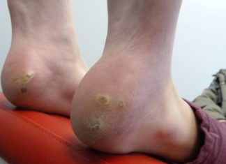 Подошвенная бородавка