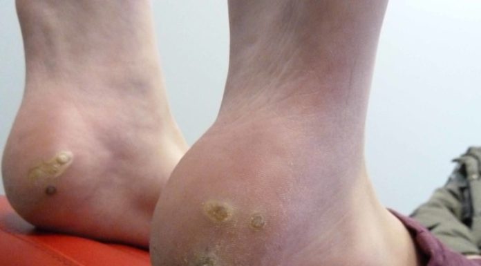 Подошвенная бородавка