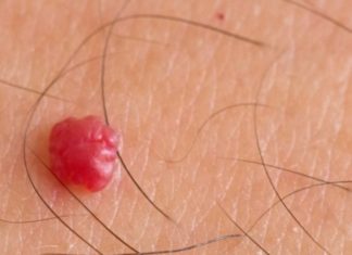 Красные, белые, коричневые бородавки