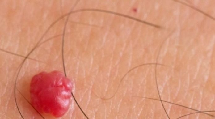 Красные, белые, коричневые бородавки