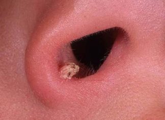 Папиллома в носу