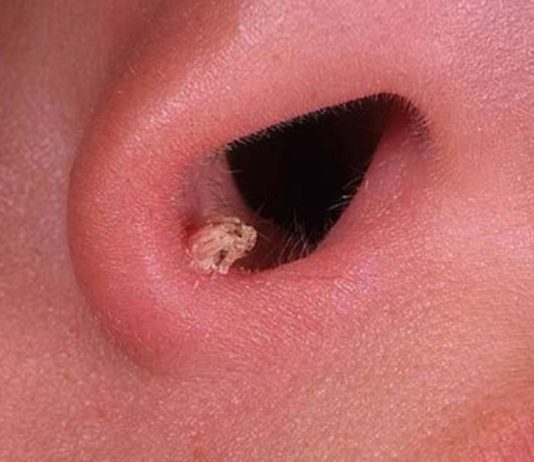 Папиллома в носу