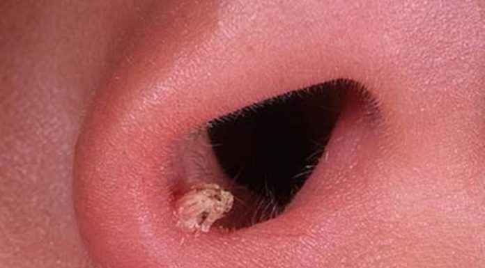 Папиллома в носу