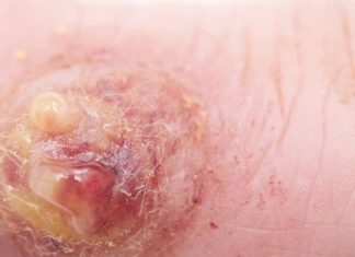 Прибор “Дарсонваль” для удаление папиллом