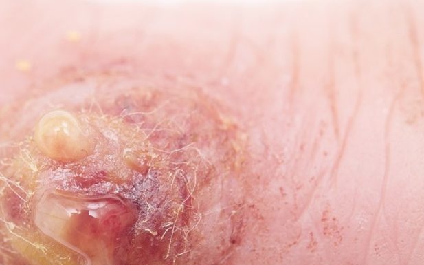 Прибор “Дарсонваль” для удаление папиллом