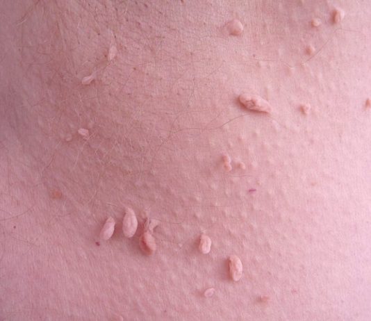 Все способы удаления папиллом