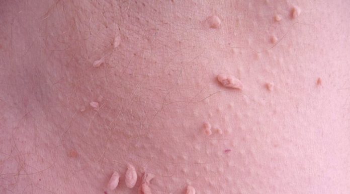 Все способы удаления папиллом