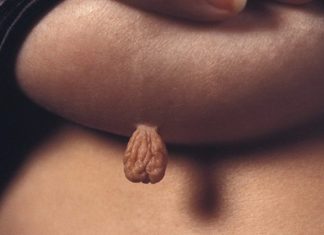 Народные средства от папиллом