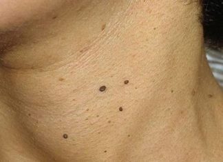 Группы маленьких папиллом. Профилактика и лечение