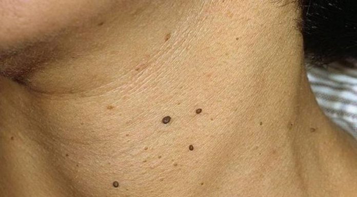 Группы маленьких папиллом. Профилактика и лечение