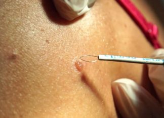 Радиоволновая деструкция папиллом