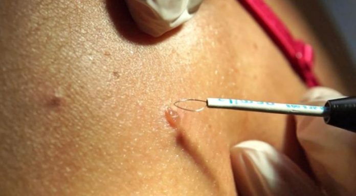 Радиоволновая деструкция папиллом