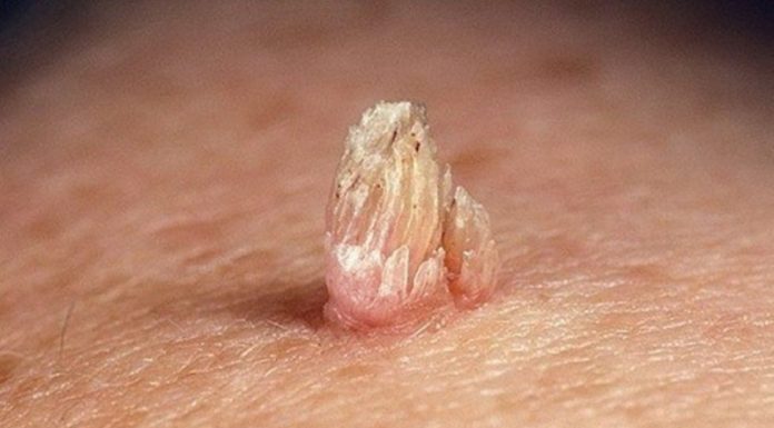 Препараты Криофарма и Вартнер Крио от папиллом