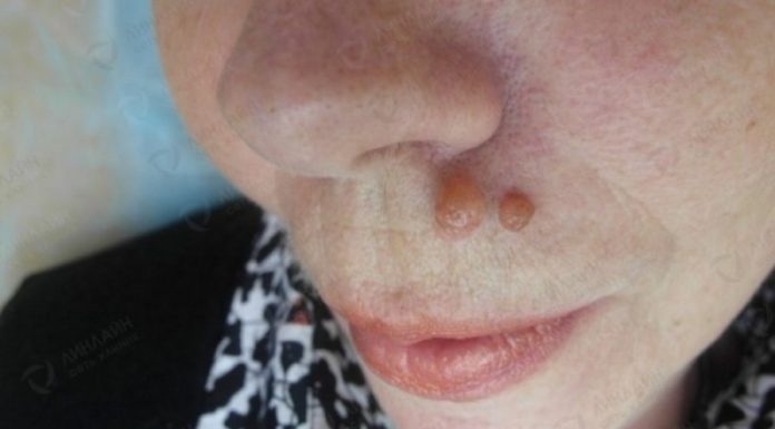 Бородавки на лице