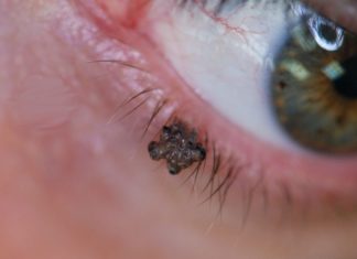 Лучшее время года для удаления папиллом