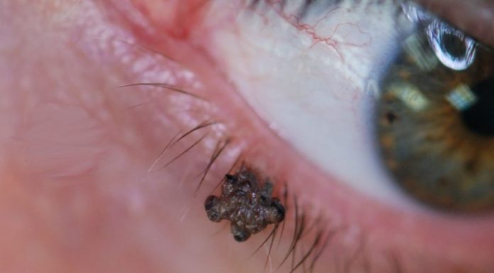 Лучшее время года для удаления папиллом