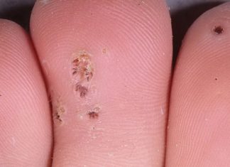 Папиломы на стопе (подошвенные), на пятках и пальцах
