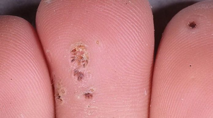 Папиломы на стопе (подошвенные), на пятках и пальцах