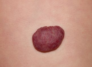 Красные, коричневые, белые папилломы