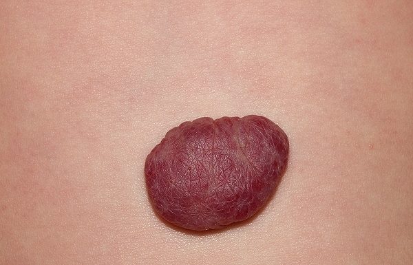 Красные, коричневые, белые папилломы