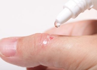 Обработка ранки после удаления папилломы