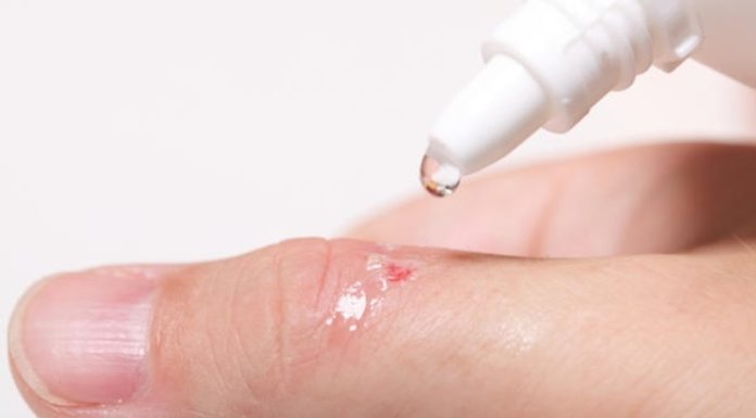 Обработка ранки после удаления папилломы