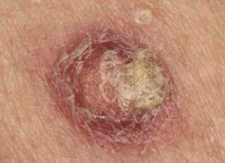 Почему болит бородавка