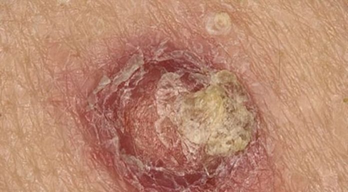 Почему болит бородавка