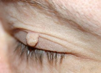 С чем связанно массовое появление папиллом