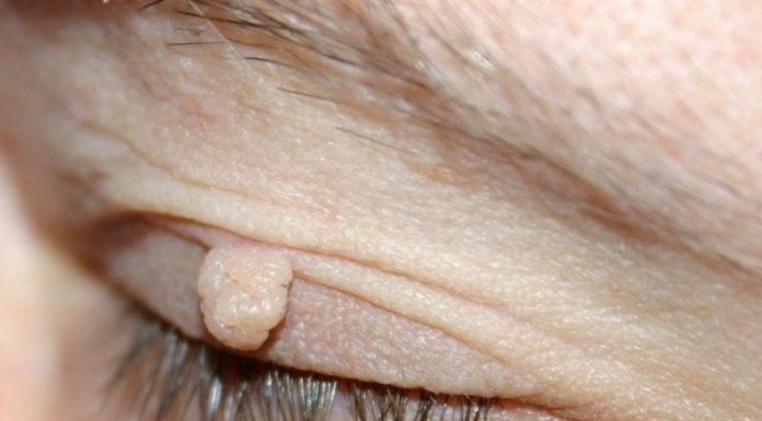 С чем связанно массовое появление папиллом