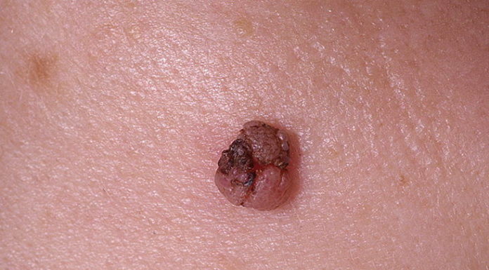 Может папиллома перерасти в рак?