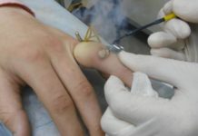 Особенности радиоволнового устранения бородавок