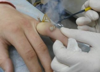 Особенности радиоволнового устранения бородавок