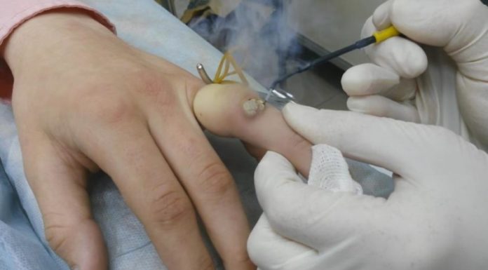 Особенности радиоволнового устранения бородавок