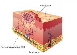 От чего появляются бородавки