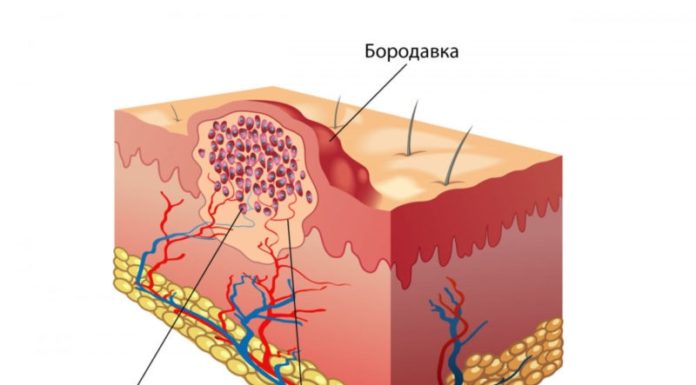 От чего появляются бородавки