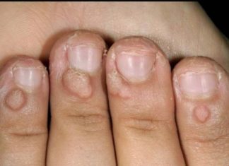 Папилломы на руках и пальцах