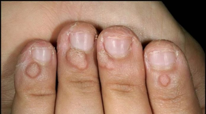 Папилломы на руках и пальцах