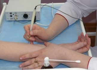 Удаление бородавок электрокоагуляцией