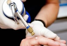 Удаление бородавок жидким азотом