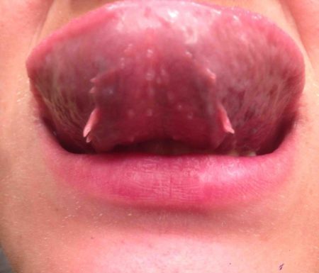 Лечение остроконечных папиллом на языке