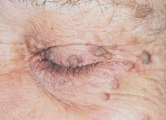 Способы удаления папиллом на лице