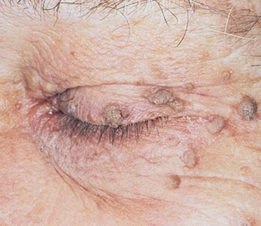 Способы удаления папиллом на лице