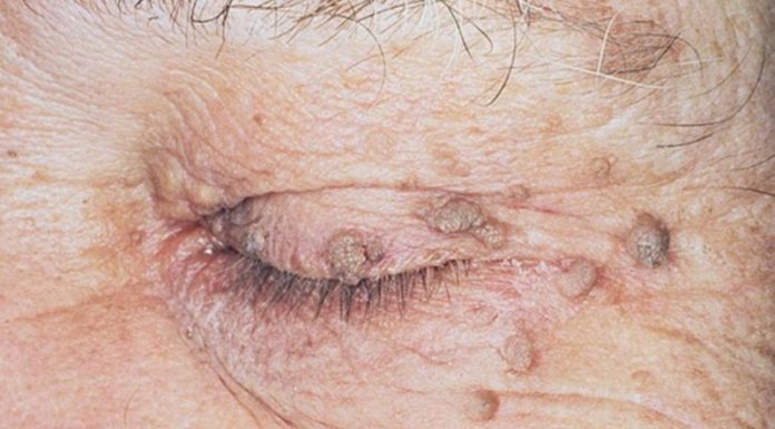 Способы удаления папиллом на лице