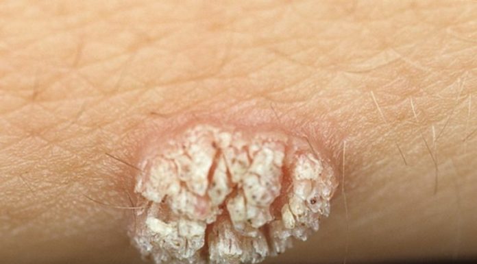 Избавимся от бородавки с помощью нитки