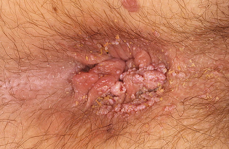 Cure genital warts on the anus hot women